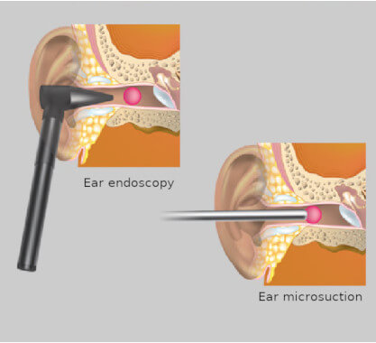 microsuction diagram